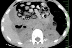 خروج بیش از ۹۰ بسته مواد مخدر از معده و روده یک مرد در کرج