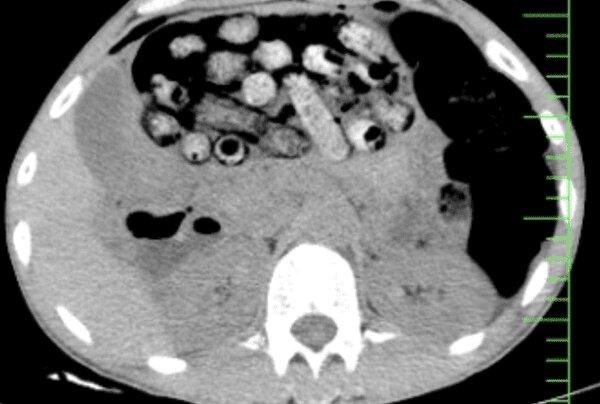 خروج بیش از ۹۰ بسته مواد مخدر از معده و روده یک مرد در کرج